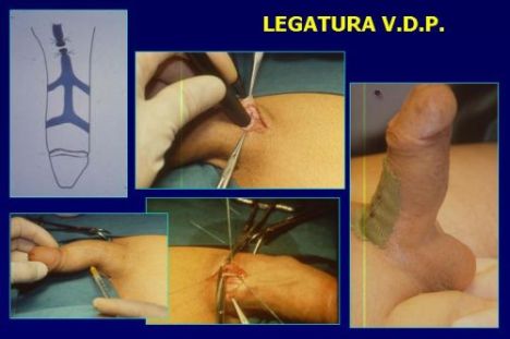 Terapia del tumore prostatico — figura 74