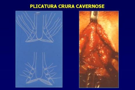 Terapia del tumore prostatico — figura 76