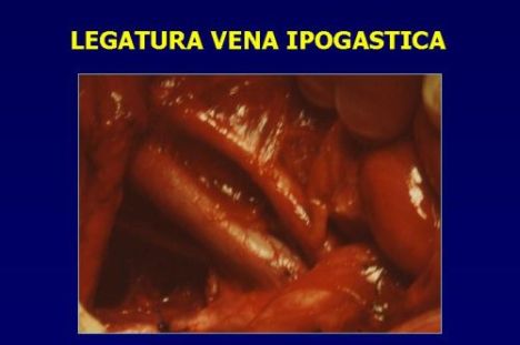 Terapia del tumore prostatico — figura 79