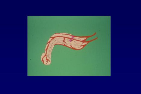Chirurgia vascolare del pene — figura 11