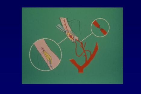 Arterializzazione vena dorsale profonda sec.virag 1-2-3- — Chirurgia vascolare del pene