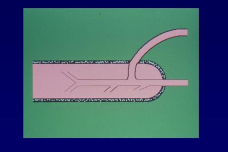 Arterializzazione vena dorsale profonda sec.virag 1-2-3- — Chirurgia vascolare del pene