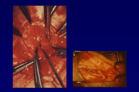 Arterializzazione vena dorsale profonda sec.virag 1-2-3- — Chirurgia vascolare del pene