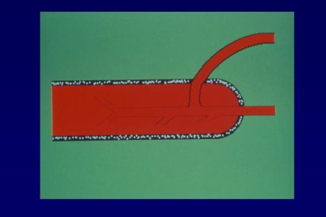Chirurgia vascolare del pene — figura 16