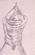 Micropene — Malformazioni congenite