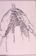 Micropene — Malformazioni congenite