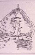 Micropene — Malformazioni congenite