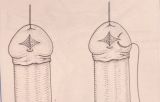 Micropene — Malformazioni congenite