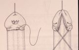 Micropene — Malformazioni congenite