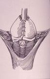 Micropene — Malformazioni congenite