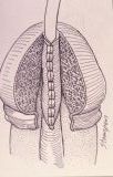 Micropene — Malformazioni congenite