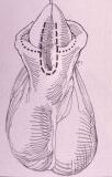 Micropene — Malformazioni congenite
