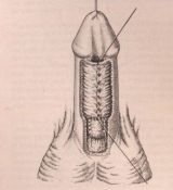 Riparazione in tempo unico — Malformazioni congenite