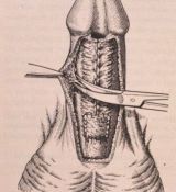 Riparazione in tempo unico — Malformazioni congenite