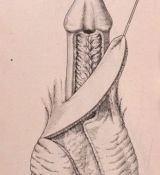Riparazione in tempo unico — Malformazioni congenite