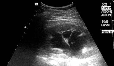 degli ureteri — Terapia del tumore della vescica