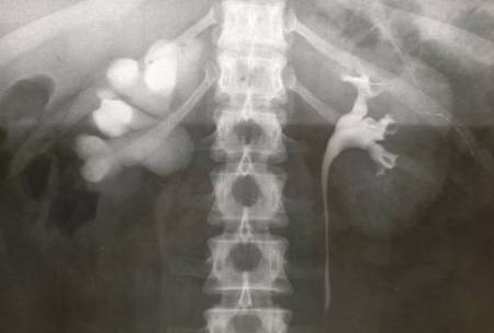 Terapia del tumore della vescica — figura 21