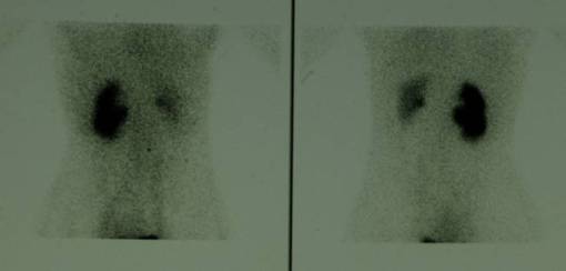 Creazione del tunnel sottomucoso per l'alloggiamento dell'uretere in corso — Terapia del tumore della vescica