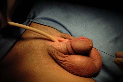 Micropene — Malformazioni congenite
