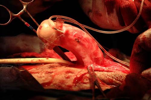 Micropene — Malformazioni congenite