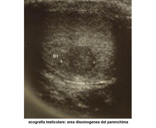 Terapia del tumore del testicolo — figura 1