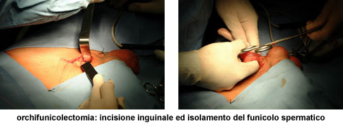 Terapia del tumore del testicolo — figura 2