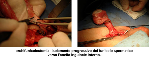 Terapia del tumore del testicolo — figura 6