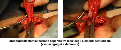 Terapia del tumore del testicolo — figura 7