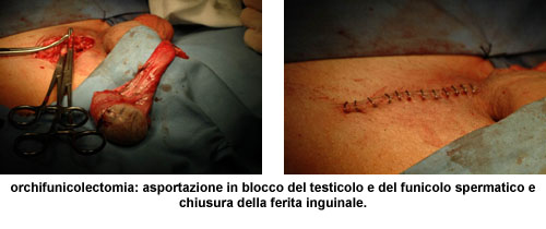 Terapia del tumore del testicolo — figura 8
