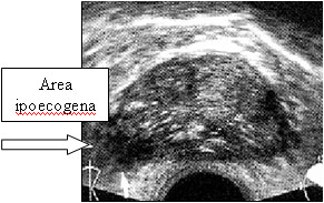 Diagnosi — Terapia del tumore prostatico