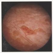 Cistiti — figura 7