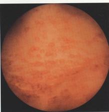 Cistiti — figura 9