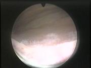 Cistiti — figura 13