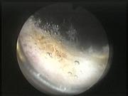 Cistiti — figura 15