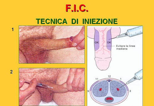 Quali esami sono necessari per diagnosticare la D.E. ? — Disfunzione erettile