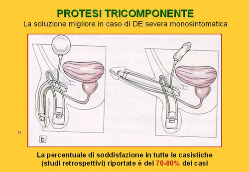 Trattamenti di 3° livello — Disfunzione erettile