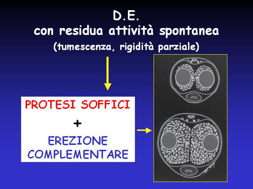 Trattamenti di 3° livello — Disfunzione erettile