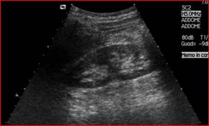 Diagnosi — Calcolosi