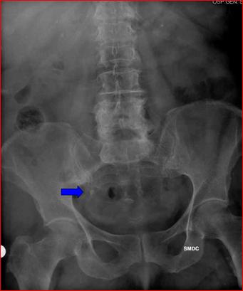 CALCOLOSI URETERALE — Calcolosi