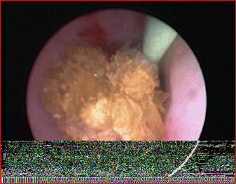 Frammentazione con laser di un calcolo ureterale — Calcolosi
