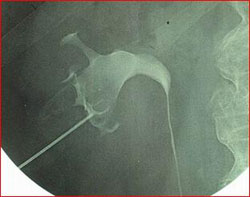 Accesso percutaneo nelle cavità renali, sotto guida combinata ecografica e radiologica — Calcolosi