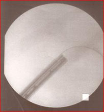 Introduzione dell'endoscopio (nefroscopio) e inizio della frammentazione del calcolo — Calcolosi