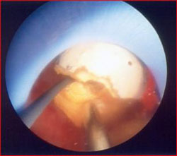 Introduzione dell'endoscopio (nefroscopio) e inizio della frammentazione del calcolo — Calcolosi