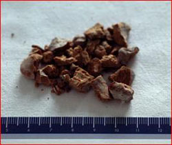 (immagine radiologica a sinistra, immagine endoscopica a destra) — Calcolosi