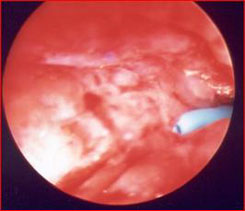 (immagine radiologica a sinistra, immagine endoscopica a destra) — Calcolosi