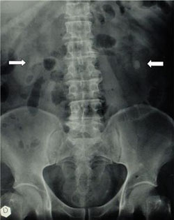 Urografia: calcolosi a stampo pielocaliciale a destra e caliciale inferiore a sinistra — Calcolosi