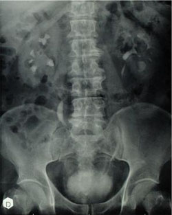 Urografia: calcolosi a stampo pielocaliciale a destra e caliciale inferiore a sinistra — Calcolosi