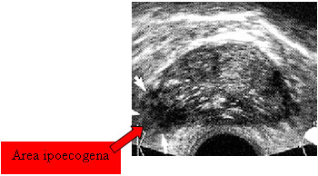 Diagnosi precoce del tumore della prostata