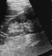 Diagnosi precoce del tumore del rene — figura 2