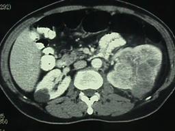 Diagnosi precoce del tumore del rene — figura 3